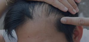 The Next Generation of Hair Loss Snake Oils
